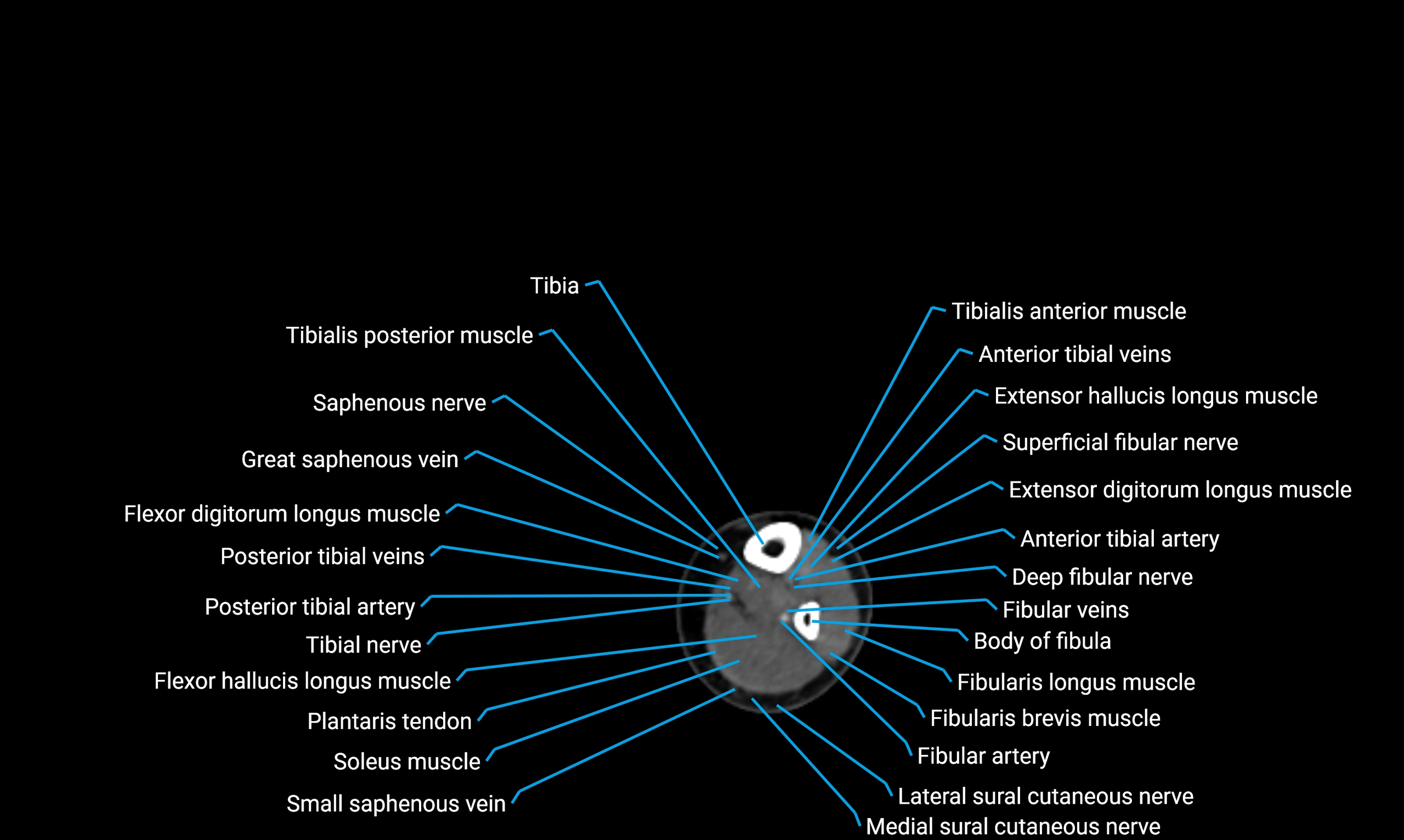 CT lower limb axial cross sectional anatomy labelled image 141 (2).webp
